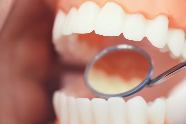 Comparing Implant Supported Dentures With Traditional Dentures