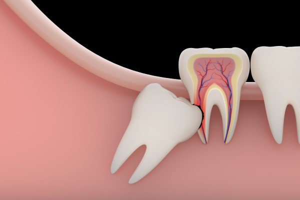 Quick Guide To Wisdom Teeth Extraction